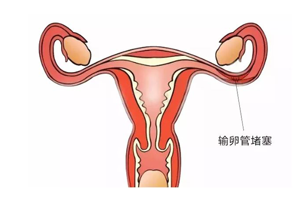 输卵管不孕怎么办？必须进行试管婴儿治疗吗？